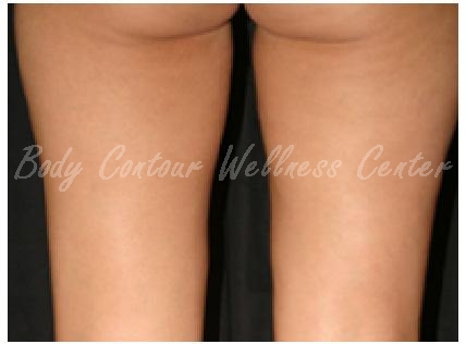 cellulite_after